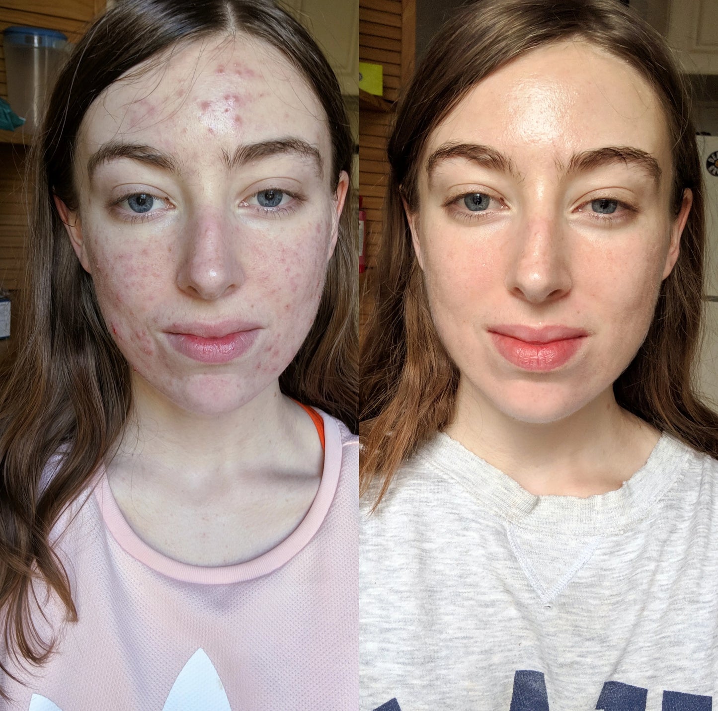 CREMA CONTROL ACNÉ